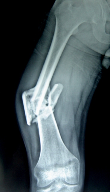 X-Ray Before Surgery